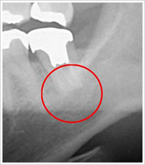 安全な抜歯を実現するCTによる精密分析
