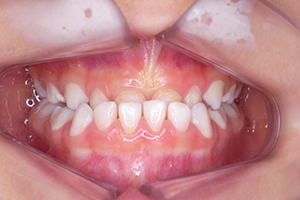 子供の歯並び／喘息／アトピー等の改善
