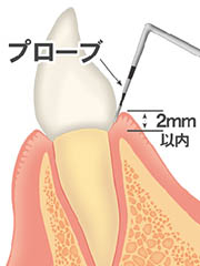 歯周病の進行度合いをチェックする検査